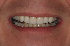 After Dental Implants patient case 7