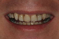Before Dental Implants patient case 7