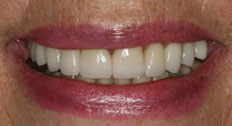 Patient Case 3 After Dental Implants