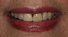 Patient Case 3 before implants