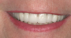 After Dental Implants Patient Case 4