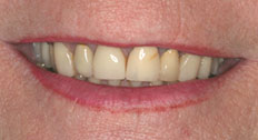 Before Dental Implants patient case 4