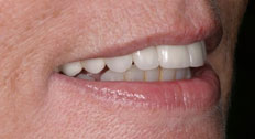 After Dental Implants patient case 5
