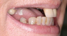Before Dental Implants patient case 5