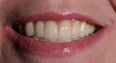 After Dental Implants patient case 6