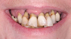 Before Dental Implants patient case 6